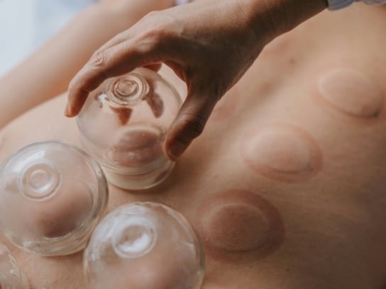 Cupping